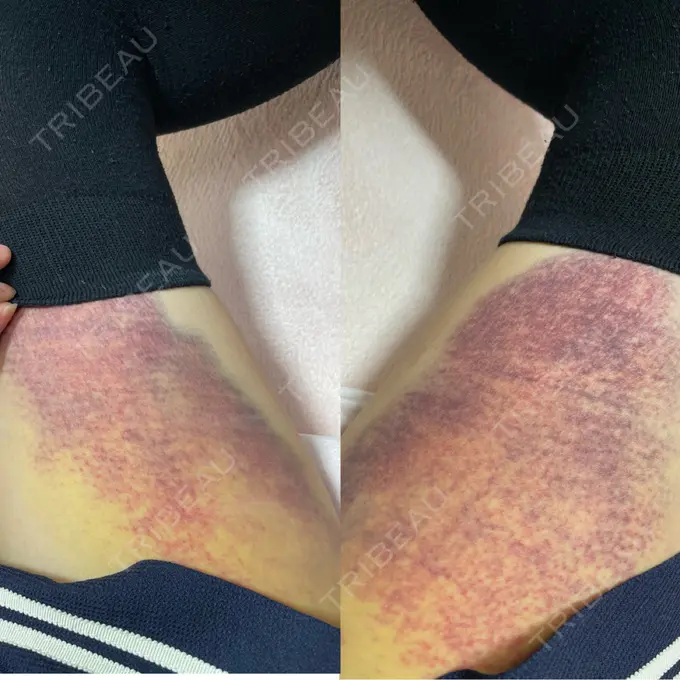 糸リフト / 脂肪吸引（顔） / 脂肪注入（額） X CLINIC 恵比寿院 DAY 5 メイン用