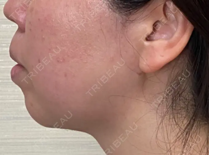 ボトックス（人中） / その他（口元） 吉井クリニック AFTER メイン用