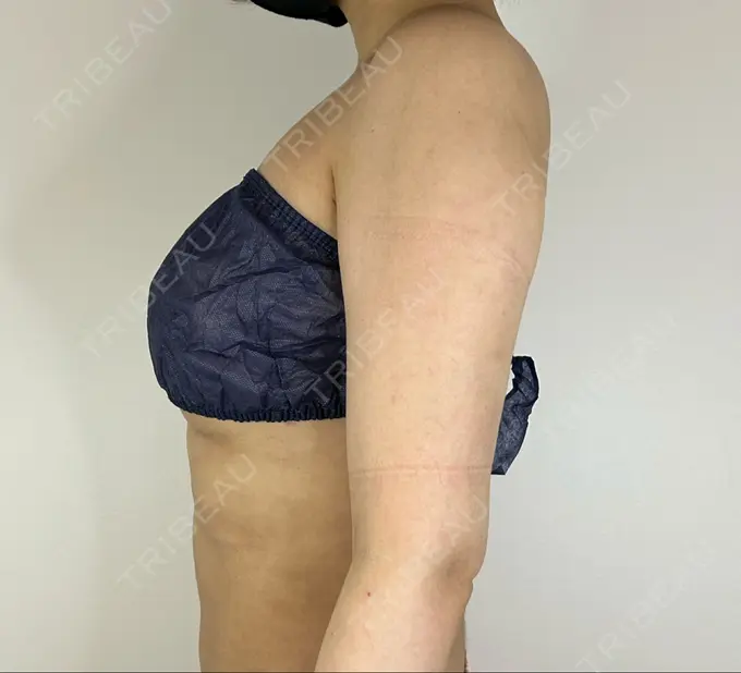 脂肪吸引（二の腕） GAYA body design clinic DAY 29 メイン用