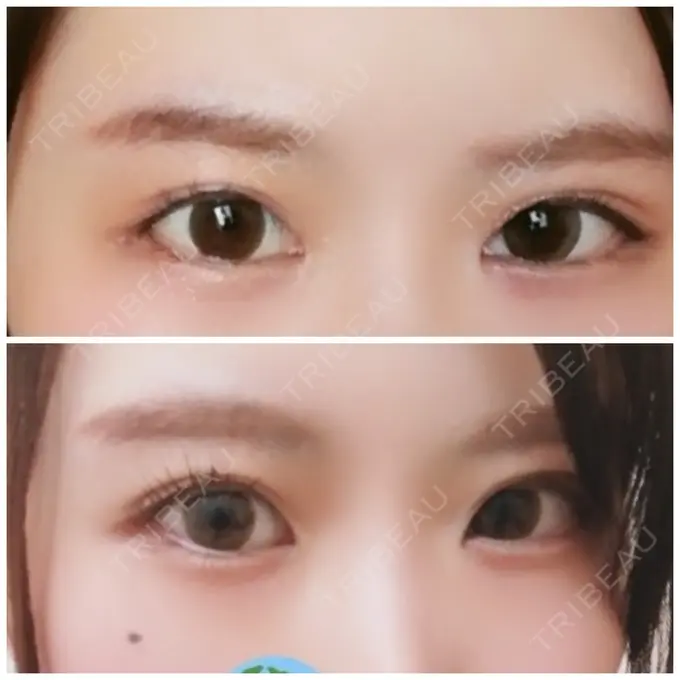 目頭切開 / 目尻切開 / 水光注射（ハリ・美肌） エートップ美容整形外科 DAY 11 メイン用