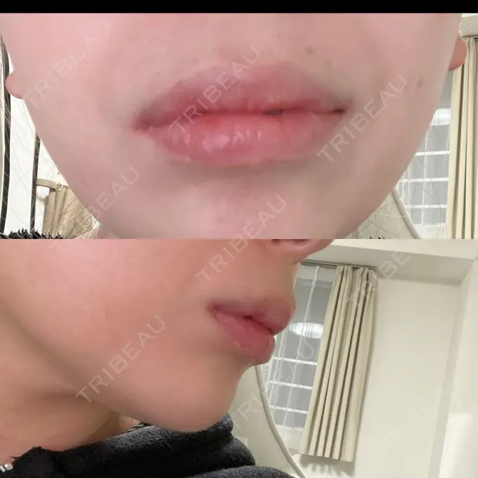 ボトックス（人中） Taide Suenaga Clinic（タイデスエナガクリニック） DAY 5 メイン用