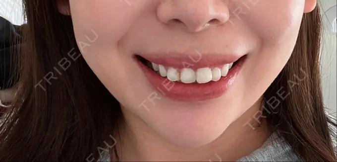 ボトックス（人中） Taide Suenaga Clinic（タイデスエナガクリニック） DAY 5 メイン用