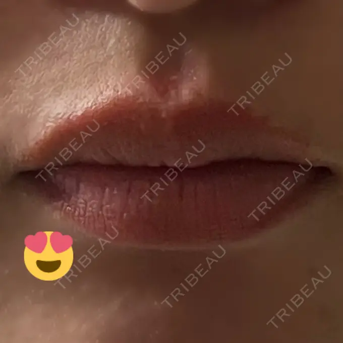 口角挙上 宇都宮竹内クリニック DAY 25 メイン用