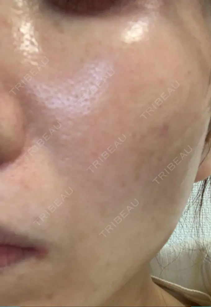 ピコレーザートーニング（美白・肝斑） 栄美容クリニック 栄院 DAY 9 メイン用