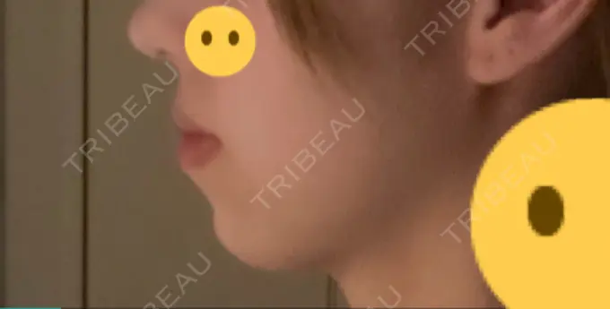 ボトックス（あご） / ヒアルロン酸注入（あご） 東京形成美容外科 船橋院 DAY 2 メイン用