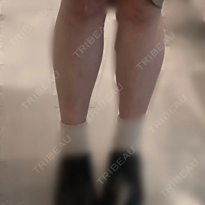 ボトックス（ふくらはぎ） LEAGRANT CLINIC 中目黒 DAY 2 メイン用