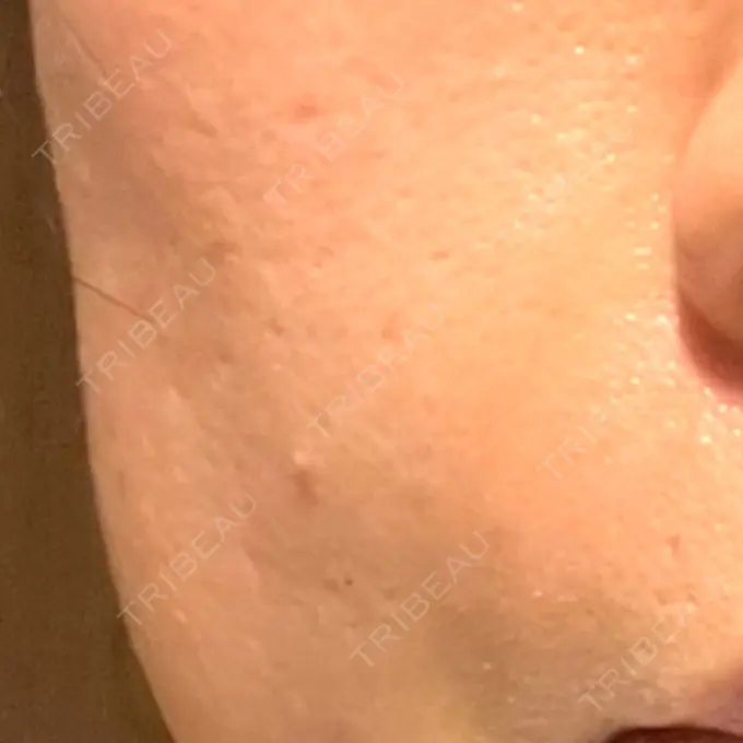 脂肪注入（肌） 湘南美容クリニック 秋葉原院 DAY 4 メイン用