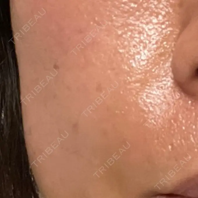 脂肪注入（肌） 湘南美容クリニック 秋葉原院 DAY 5 メイン用