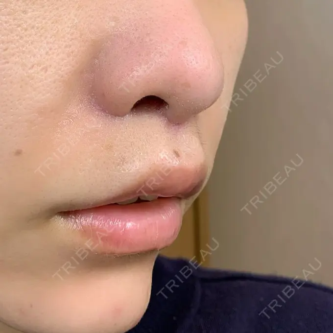 小鼻縮小（切開） / 人中短縮 / 鼻翼挙上 Otus Clinic 【オータスクリニック】 DAY 11 メイン用