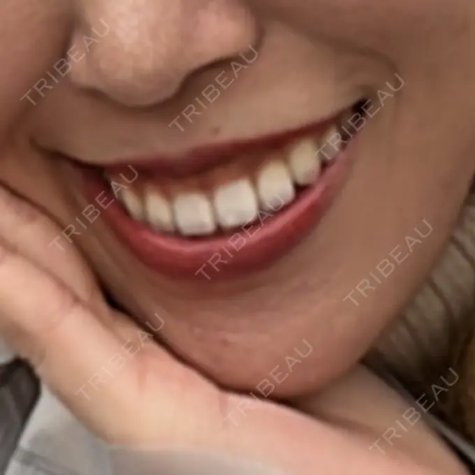 ボトックス（ガミースマイル） あいちビューティークリニック栄本院 DAY 4 メイン用