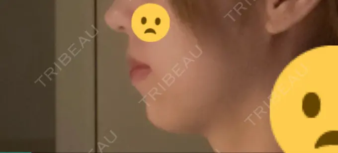 ボトックス（あご） / ヒアルロン酸注入（あご） 東京形成美容外科 船橋院 DAY 3 メイン用