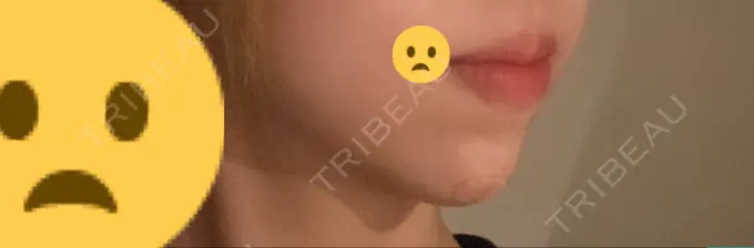 ボトックス（あご） / ヒアルロン酸注入（あご） 東京形成美容外科 船橋院 DAY 3 メイン用