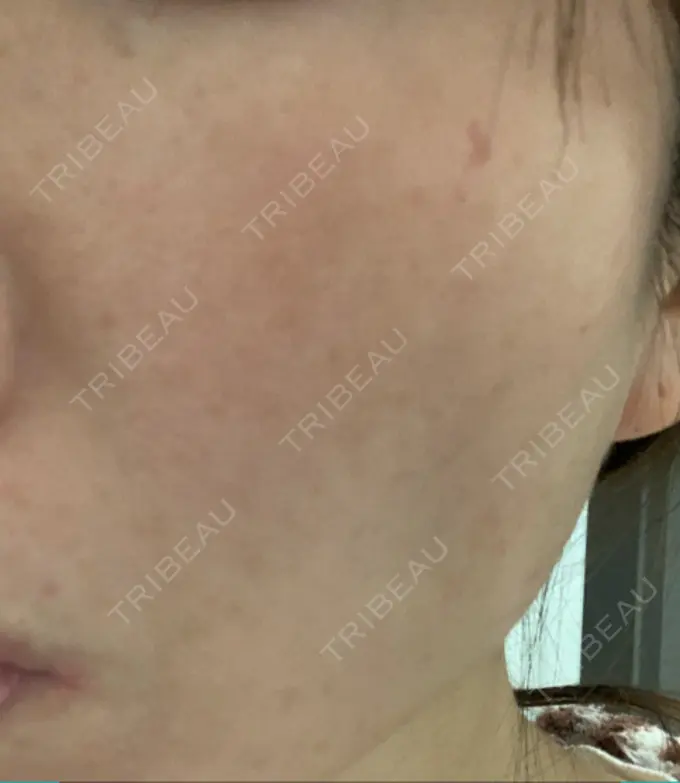 ピコレーザートーニング（美白・肝斑） 栄美容クリニック 栄院 DAY 11 メイン用