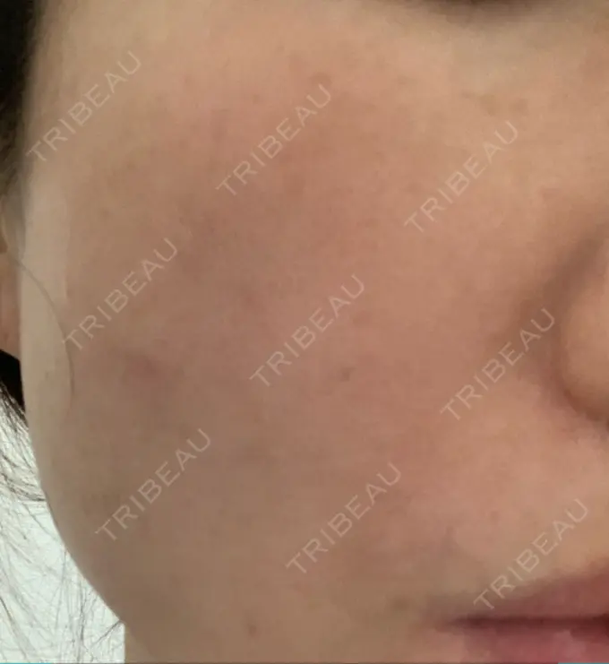 ピコレーザートーニング（美白・肝斑） 栄美容クリニック 栄院 DAY 11 メイン用