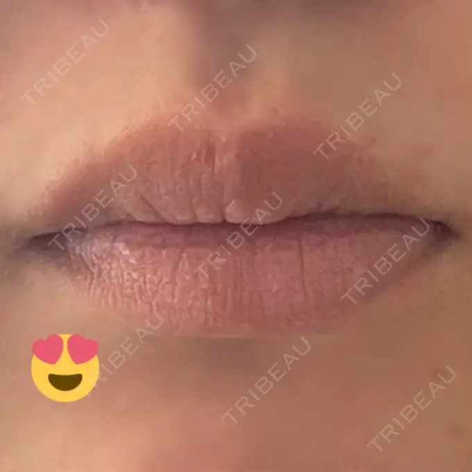 口角挙上 宇都宮竹内クリニック DAY 27 メイン用