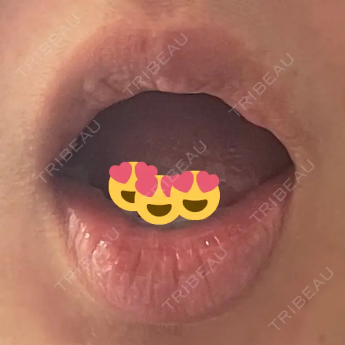 口角挙上 宇都宮竹内クリニック DAY 27 メイン用