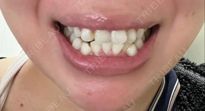 ホワイトニング 東京素肌クリニック 新宿院 AFTER メイン用