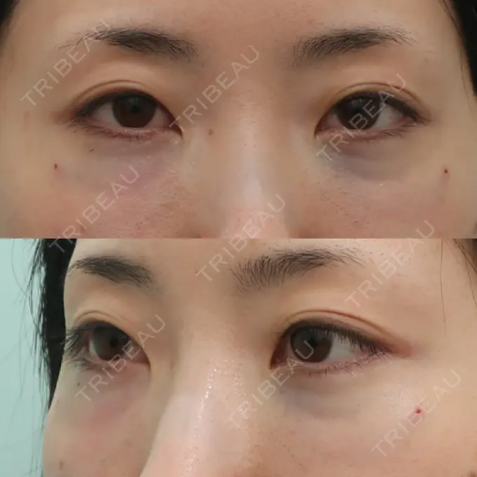 下まぶたの脂肪取り / 脂肪注入（目の下） WOM CLINIC GINZA （ワム クリニック ギンザ） DAY 0 メイン用