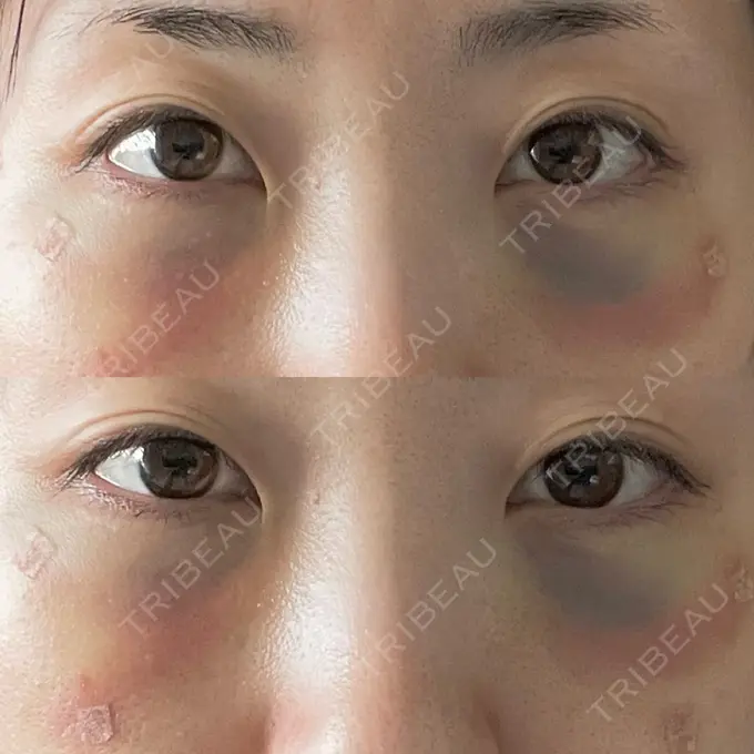 下まぶたの脂肪取り / 脂肪注入（目の下） WOM CLINIC GINZA （ワム クリニック ギンザ） DAY 1 メイン用