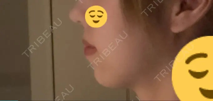 ボトックス（あご） / ヒアルロン酸注入（あご） 東京形成美容外科 船橋院 DAY 4 メイン用