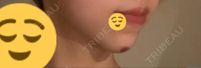 ボトックス（あご） / ヒアルロン酸注入（あご） 東京形成美容外科 船橋院 DAY 4 メイン用