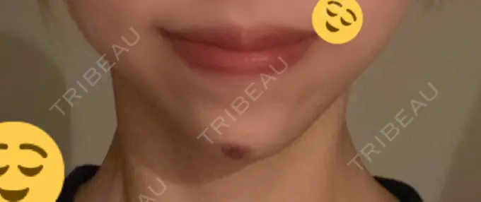 ボトックス（あご） / ヒアルロン酸注入（あご） 東京形成美容外科 船橋院 DAY 4 メイン用