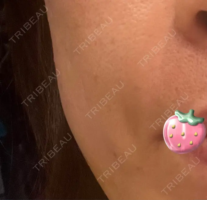 脂肪注入（肌） 湘南美容クリニック 秋葉原院 DAY 6 メイン用