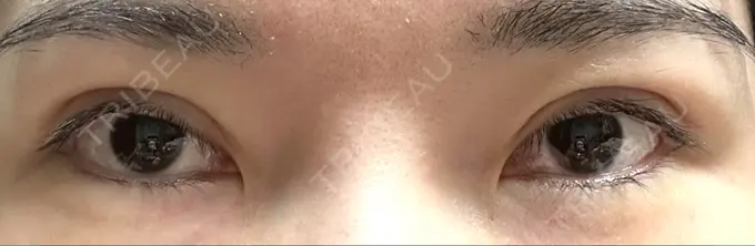 二重切開 / 眼瞼下垂（切開） / 目元修正 城本クリニック 姫路院 DAY 91 メイン用