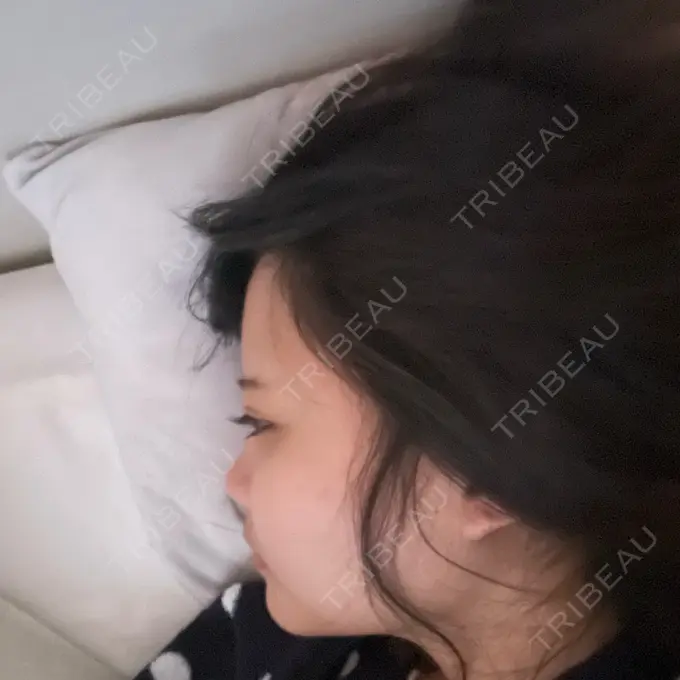 糸リフト / 脂肪吸引（顔） / 脂肪注入（額） X CLINIC 恵比寿院 AFTER メイン用