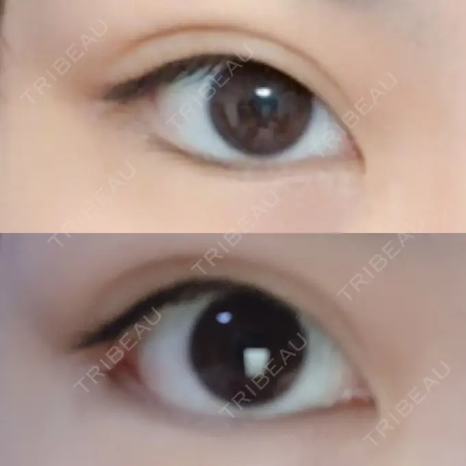 目尻切開 / タレ目形成・グラマラスライン（切開） / 目尻靭帯移動 FROM B整形外科 (旧バウム整形外科) DAY 33 メイン用