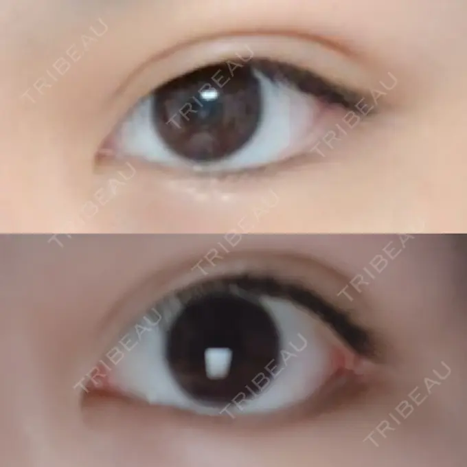 目尻切開 / タレ目形成・グラマラスライン（切開） / 目尻靭帯移動 FROM B整形外科 (旧バウム整形外科) DAY 33 メイン用