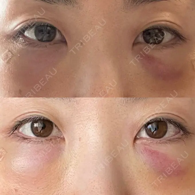 下まぶたの脂肪取り / 脂肪注入（目の下） WOM CLINIC GINZA （ワム クリニック ギンザ） DAY 2 メイン用