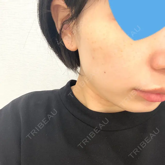 ピコレーザートーニング（美白・肝斑） ルラ美容クリニック 名古屋本院 DAY 0 メイン用