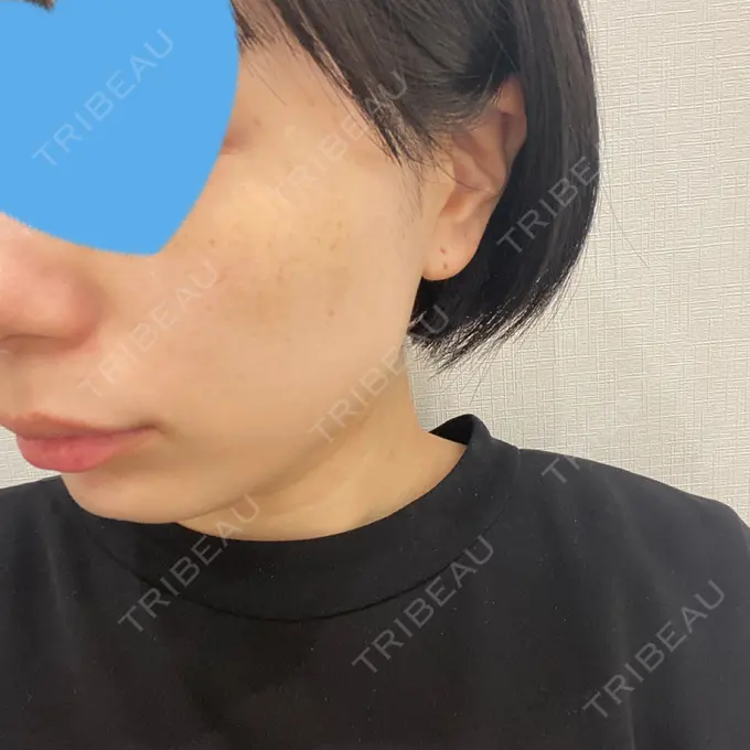 ピコレーザートーニング（美白・肝斑） ルラ美容クリニック 名古屋本院 DAY 0 メイン用