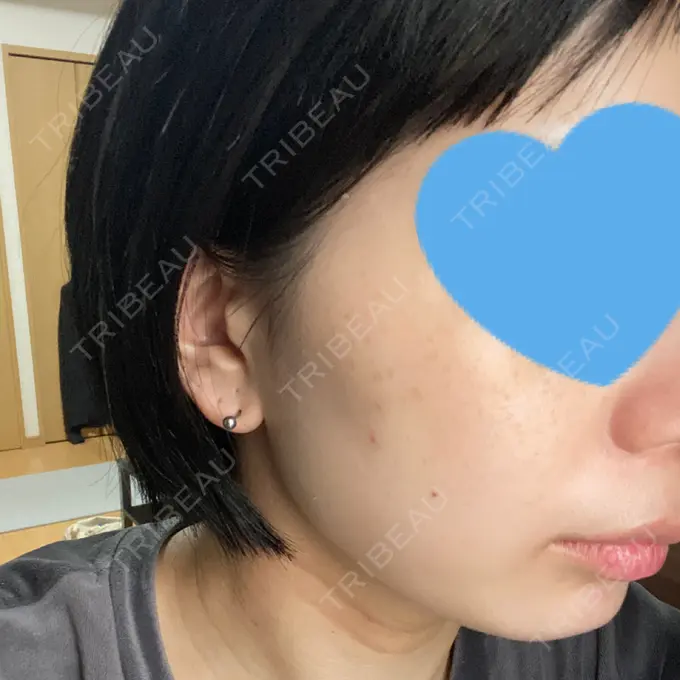 ピコレーザートーニング（美白・肝斑） ルラ美容クリニック 名古屋本院 DAY 1 メイン用