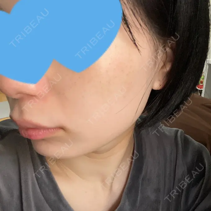 ピコレーザートーニング（美白・肝斑） ルラ美容クリニック 名古屋本院 DAY 1 メイン用