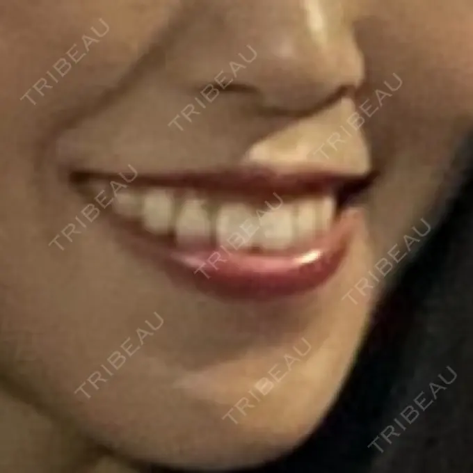 ボトックス（ガミースマイル） あいちビューティークリニック栄本院 AFTER メイン用