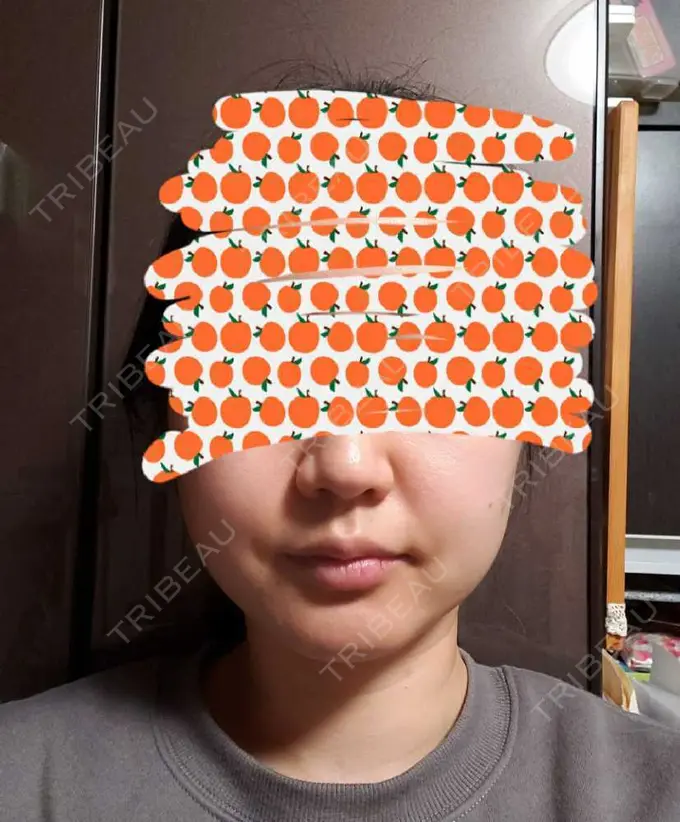 ボトックス（エラ・小顔） TCB東京中央美容外科 自由が丘院 DAY 2 メイン用