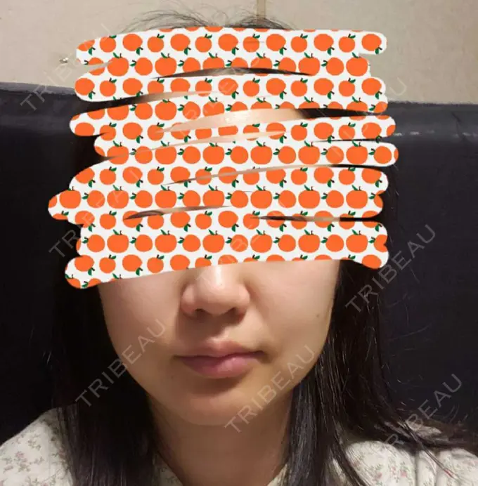 ボトックス（エラ・小顔） TCB東京中央美容外科 自由が丘院 DAY 12 メイン用