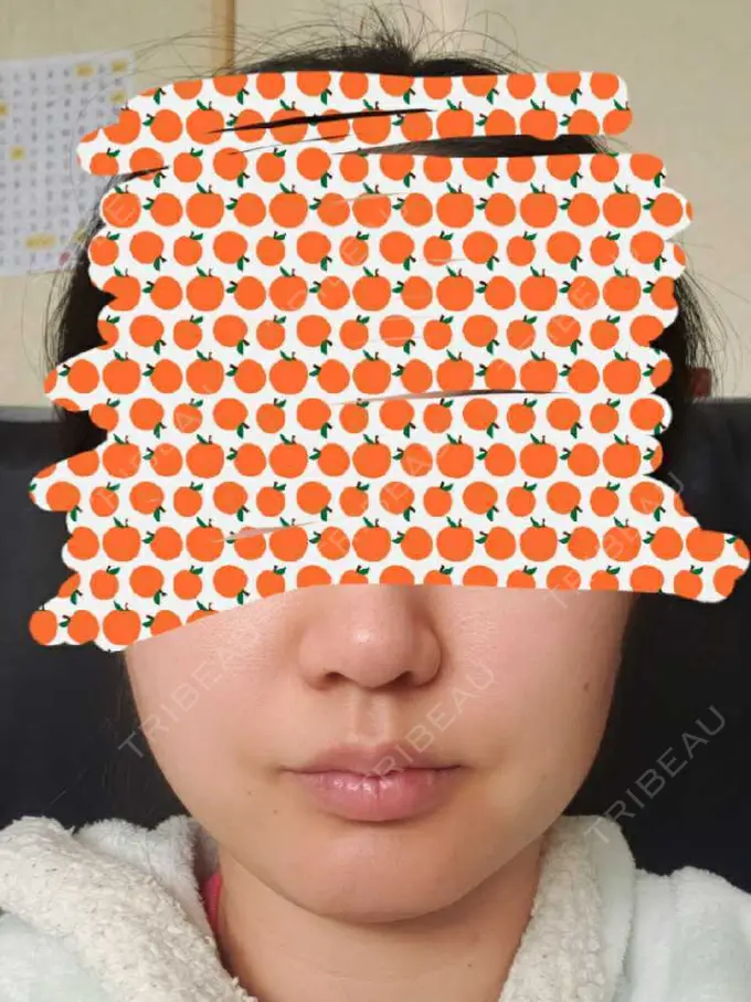 ボトックス（エラ・小顔） TCB東京中央美容外科 自由が丘院 AFTER メイン用