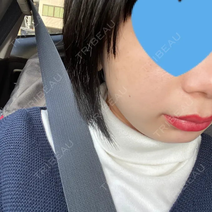 ピコレーザートーニング（美白・肝斑） ルラ美容クリニック 名古屋本院 DAY 2 メイン用