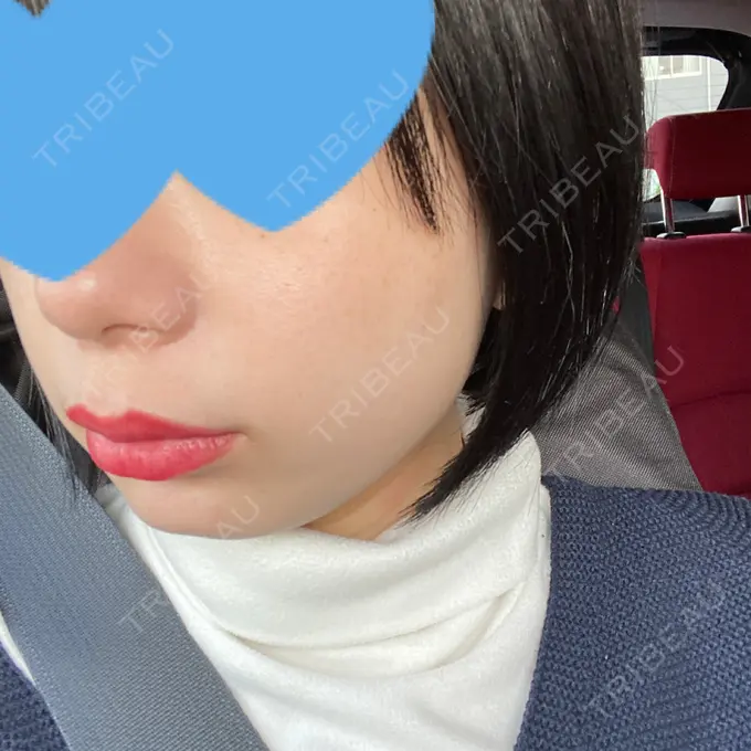 ピコレーザートーニング（美白・肝斑） ルラ美容クリニック 名古屋本院 DAY 2 メイン用