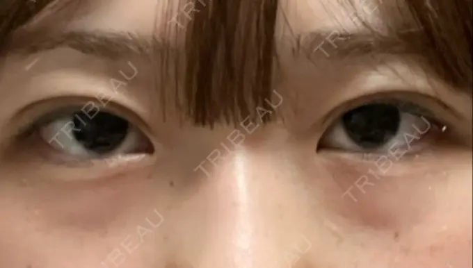 二重埋没 水の森美容クリニック 東京銀座院 DAY 3 メイン用