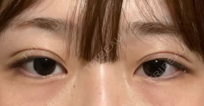 二重埋没 水の森美容クリニック 東京銀座院 DAY 3 メイン用