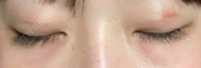 二重埋没 水の森美容クリニック 東京銀座院 DAY 3 メイン用