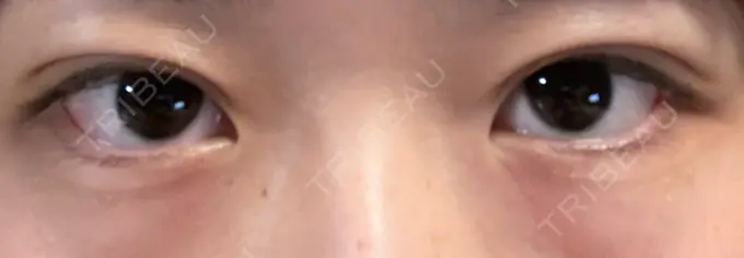 二重埋没 水の森美容クリニック 東京銀座院 DAY 4 メイン用