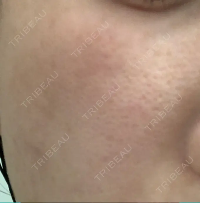 ピコレーザートーニング（美白・肝斑） 栄美容クリニック 栄院 DAY 14 メイン用