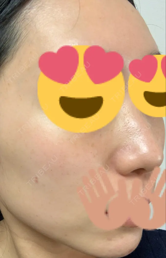 ほくろ・いぼ切除（肌） / 高濃度ビタミンC点滴 TCB東京中央美容外科 広島院 DAY 77 メイン用