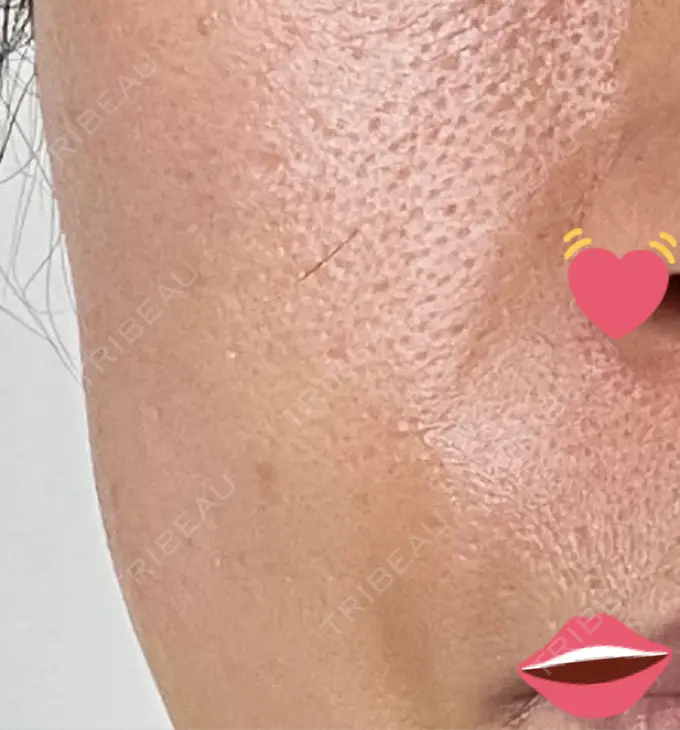 脂肪注入（肌） 湘南美容クリニック 秋葉原院 DAY 8 メイン用