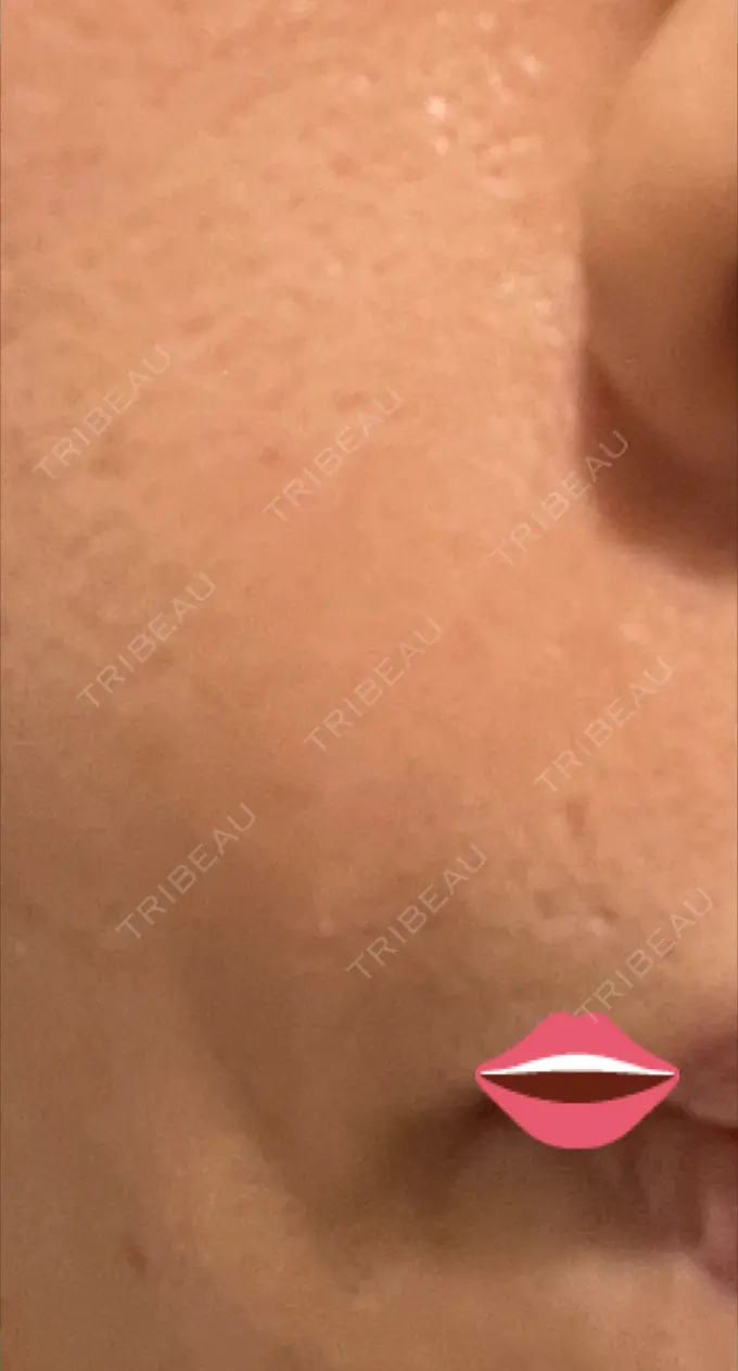 脂肪注入（肌） 湘南美容クリニック 秋葉原院 DAY 9 メイン用